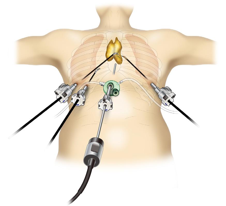 Japan Figure 1 Robot-assisted thymectomy using a lateral approach. This method involves approaching via an intercostal space of the lateral chest.