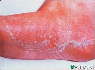 3. Fungi a. Most do not cause disease. b. Most common fungal infections are those of the skin (i.e. types of ringworm; such as athlete s foot-rough, irritable patches on the toes.