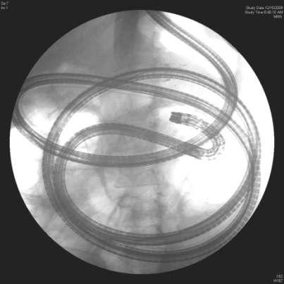 Balloon enteroscopy caveats Surgical anatomical caveats: fixed bowel Roux-en-Y anatomy Anastomoses Ectatic