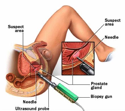 Conventional TRUS Biopsy Introduced in 1989 A needle attached to a spring loaded biopsy gun Transrectal ultrasound probe is inserted into the rectum to directly image the prostate