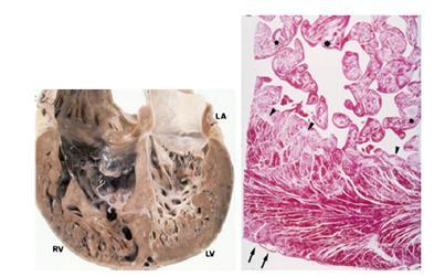 - Loosely organized myocytes with focal compensatory hypertrophy, focal ischemic necrosis within endocardial layer, fibrous and elastin deposition.
