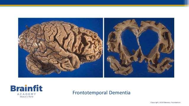 Slide 9 In this slide you can see the devastating damage done to the frontal and sometimes temporal lobes in Frontotemporal lobe dementia.