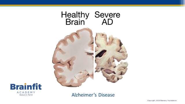 Slide 10 Alzheimer s disease is the most common form of dementia.