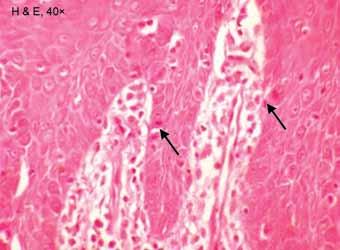 2: H&E, Feulgen and crystal violet stained sections showing MFs and severe epithelial dysplasia was observed (Table 3).
