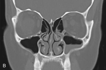 Acute bacterial sinusitis. Axial CT scan ( A ) shows an air-fluid level in the right antrum. The attenuation of this fluid is less than that of muscle and typically is watery sinus secretions.