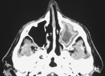 Acute bacterial sinusitis. Axial contrast-enhanced CT scans of three different patients. A, Enhancement of the inflamed mucosa within the left maxillary sinus.