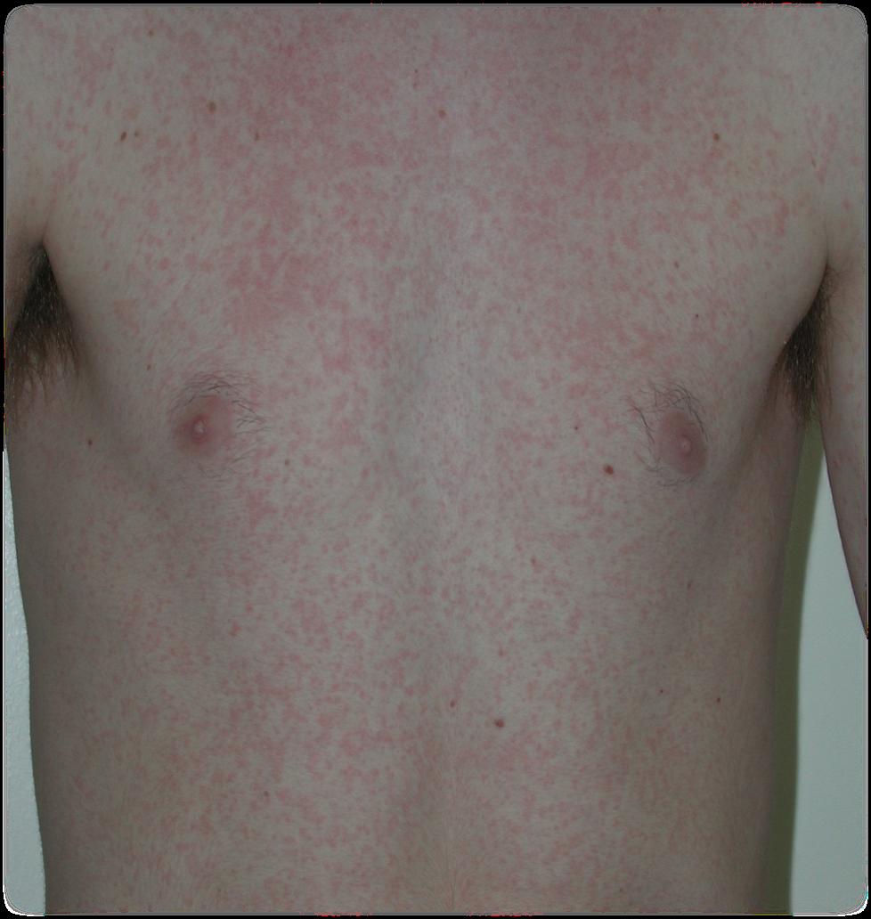 rash after treatment
