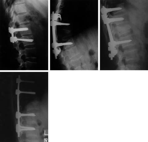 A B C Fig 1 Various types of the modular construct in posterior spinal instrumentation D REFERENCES 01) Argenson C, de Peretti F, Lacour C, Puch JM, Cambas PM and Hovorkca E : Burst fractures of the
