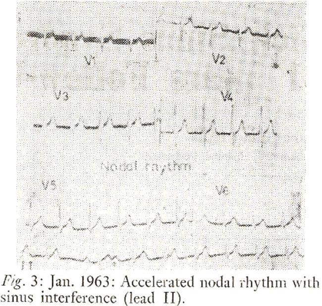 occasions; one recording during 1963 demonstrated nodal escape activity (Fig.