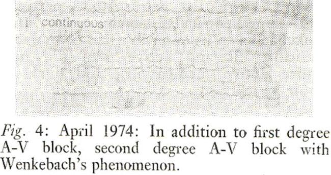 An electrocardiogram recorded during 1978 showed sinus irregularity with nodal escape activity. He died, in an air crash during 1979.