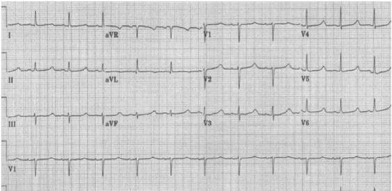 Case 4 - ECG Characteristic initiating sequence of TdP Case 4 Causes of QT prolongation A 35 year-old female presents with dizziness x 2
