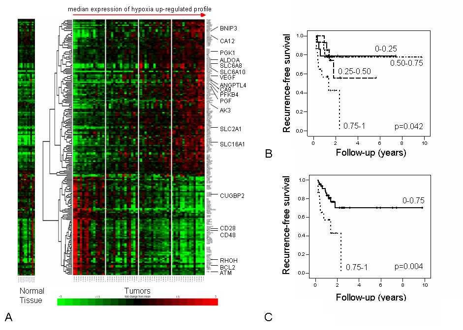 radiotherapy response A 99-gene hypoxia associated signature Prediction of response to radiotherapy in cervical cancer.