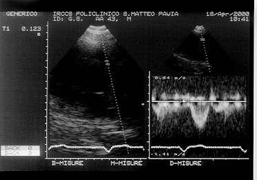 to Aortic Ejection = 230 ms) ( 1 ) Prolonged aortic