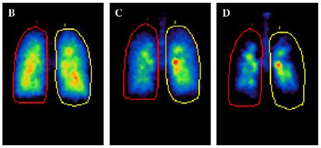 5 µm 3 µm 6 µm Total Lung Deposition 56 51 46 % of Total Delivered Dose Peripheral Lung Central Lung Deposition Deposition 25