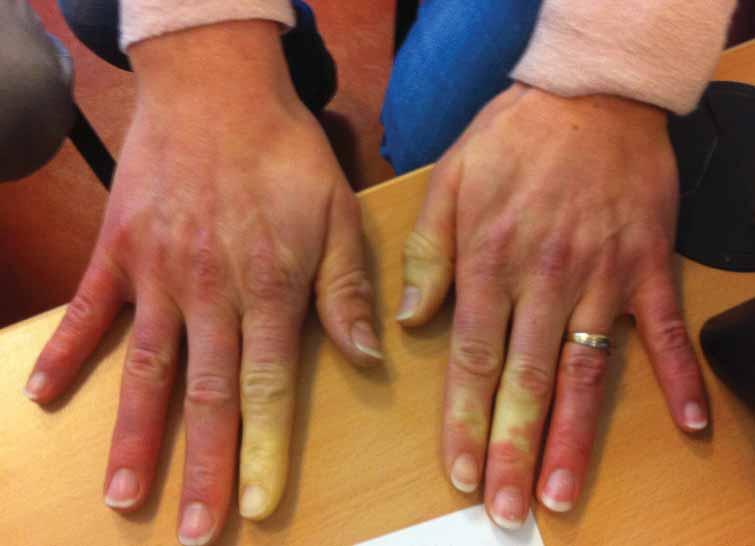 FIGURE 1 Raynaud s phenomenon in a patient positive for anti-pl7 antibodies.