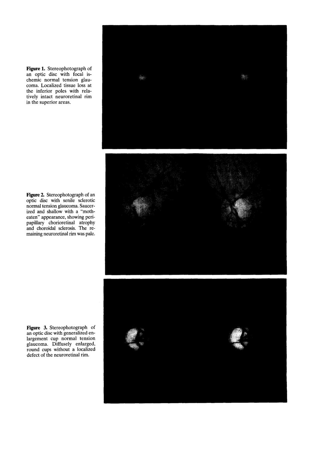 Figure 1. Stereophotograph of an optic disc with focal ischemic normal tension glaucoma. Localized tissue loss at the inferior poles with relatively intact neuroretinal rim in the superior areas.