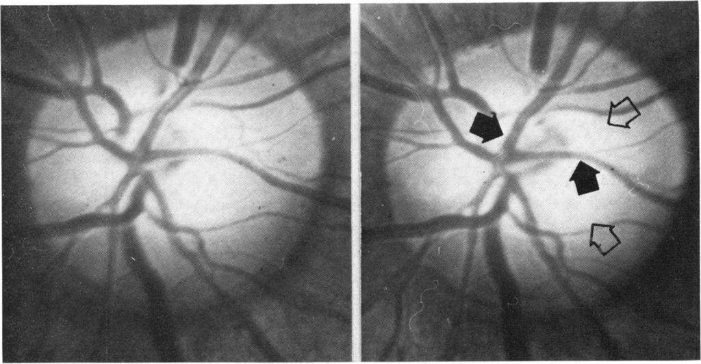 780 British Yournal of Ophthalnmology Table Clinical features of glaucomatous discs Tvpe No. Percentage of total I. Normal 231 46 o-o-6 0-3 223 2. Overpass vessels 44 9 3.