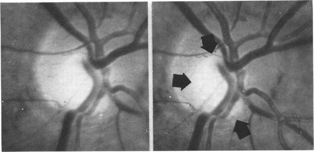 782 British yournal of Ophthalmology FIG. 4 Focal notching of the neuroretinal rim; neuroretinal rim is very thin in one localized segment.
