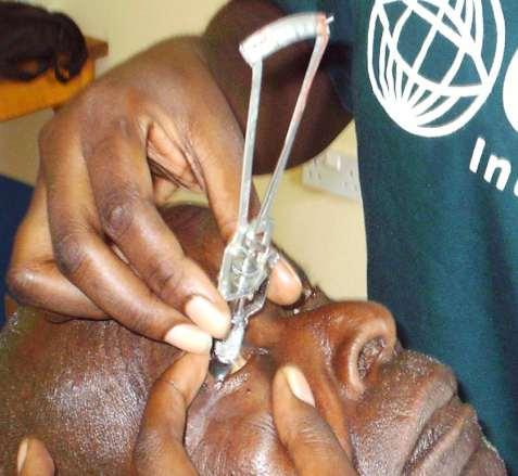 Who is diagnosing and treating glaucoma in Africa Glaucoma Specialist Ophthalmologist