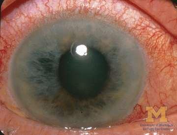 Angle Closure Glaucoma Signs DRAMATIC Cloudy/steamy cornea