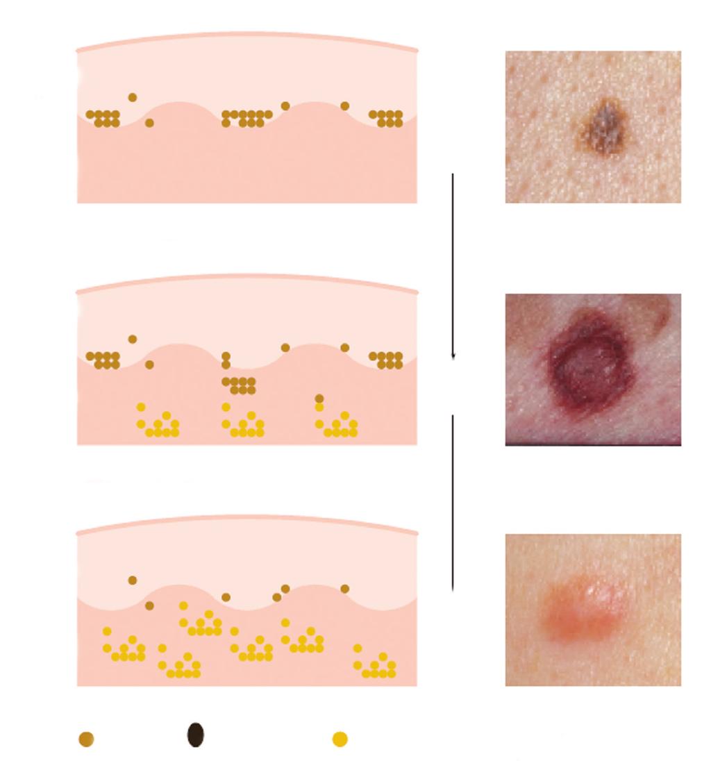 Normal changes in moles as you get older When they first appear moles are flat and brown.