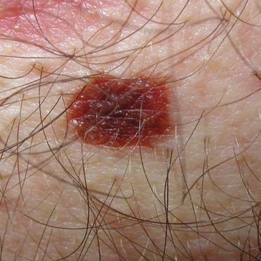 Atypical moles are a little more likely to become a melanoma than others.