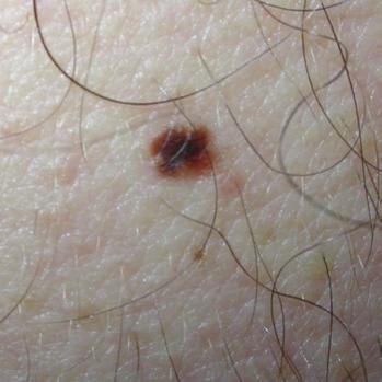 This atypical mole is red/ inflamed in appearance.