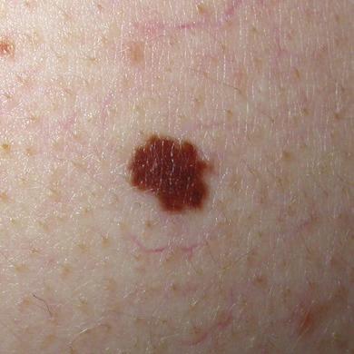 This atypical mole is very irregular in shape.