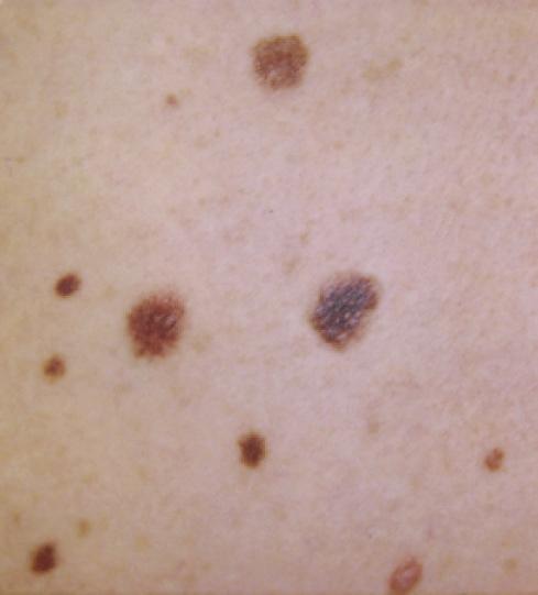 Superficial spreading melanomas These are melanomas which initially grow laterally (sideways) in the epidermis. This is known as the radial growth phase.