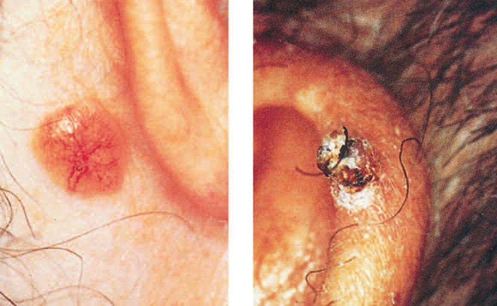 Figure 2. Basal cell carcinoma (left) and squamous cell carcinoma (right). Reprinted by permission from the New England Journal of Medicine, 326, 169-170, 1992. sores that won t heal.