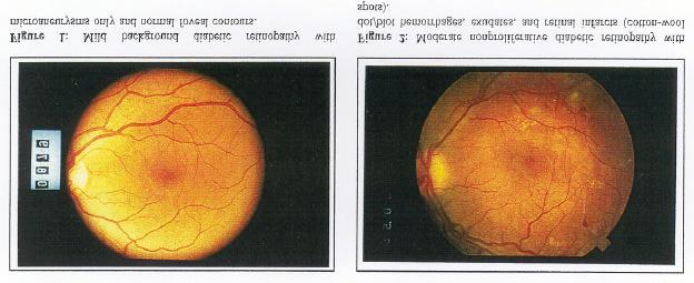 DIABETIC RETINOPATHY C. L. B. Canny, MD FRCSC Diabetic retinopathy is the most serious eye manifestation of diabetes and is responsible for most of the blindness caused by diabetes.