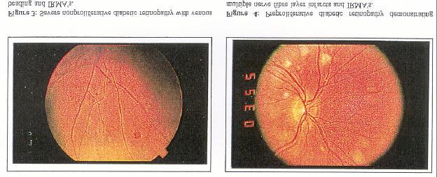 2. PREPROLIFERA TIVE: Severe amount of dot/blot hemorrhages, retinal infarcts, IRMA s, and venous beading without