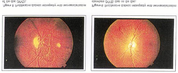 Risk of progression to proliferative retinopathy is 80% in 5 years! 3. PROLIFERATIVE: The presence of NEOVA.
