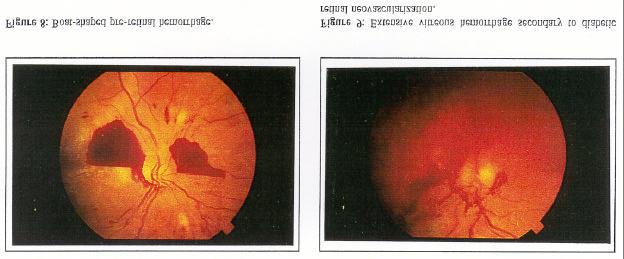 demonstrated the risk of moderate visual loss to be 6% per year untreated in patients