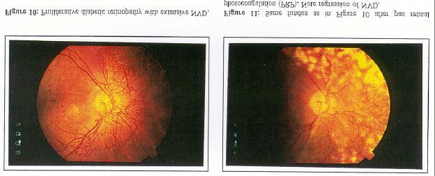 3. TRACTION RETINAL DKTACHMKNT: Vitreous hemorrhage and traction retinal detachment are complications of proliferative The Diabetic Retinopathy Study (DRS, 1976) demonstrated the risk of major visual