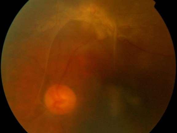 Fibrous tissue proliferation Localized retinal
