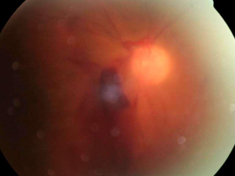 Vitreous Hemorrhage (VH) Cloudy view of