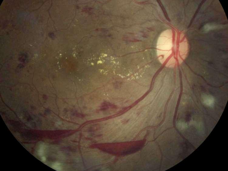 Preretinal Hemorrhages Lower edge of PRH below confined by