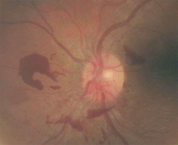 Case 2: 24 year old Latin American female Image from EyePACS visit on 7/16/2009: HbA1c 9.