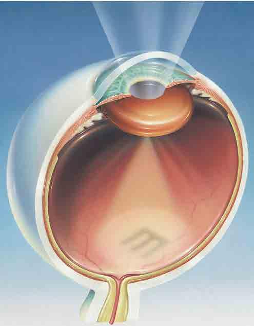 CATARACTS A cataract is a clouding of the lens in the eye. Without treatment, cataracts can eventually lead to blindness.
