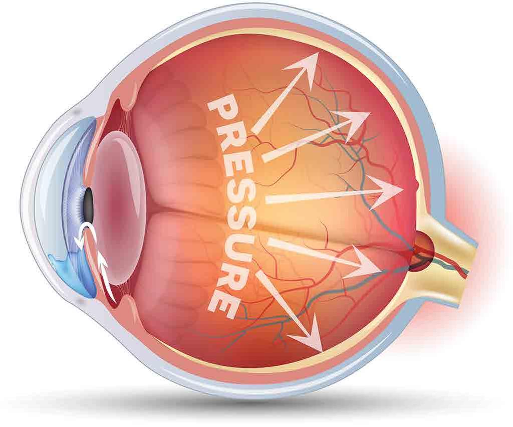 GLAUCOMA Glaucoma is a group of conditions that lead to damage of the eye (optic) nerve. The optic nerve transmits signals from the retina to the brain for processing.