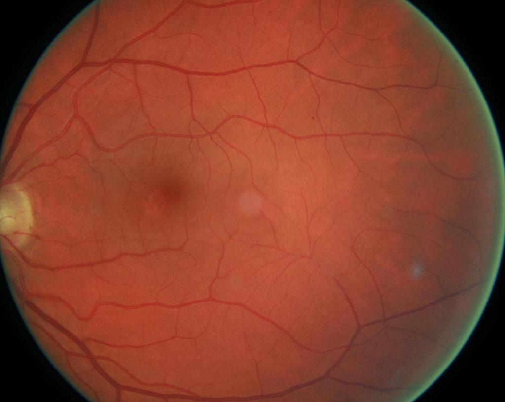 Fundus Signs of