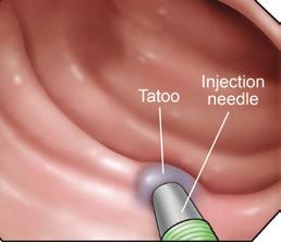 Spot tattoos were placed near the diverticulum with the NBVV, to help relocate