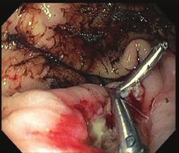 Also some current hemoclips reach 2-3 mm into the submucosa and can seal the