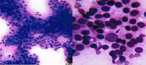 Figure 2 (a) FNAC Papillary carcinoma (MGG X 400) (b) Arrow showing intranuclear inclusions (MGG X 1000) Table 2: Cyto-Histopathological correlation in Thyroid lesions No.