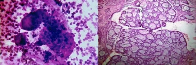 Salivary Gland Lesions Of 49 cases (16.95%) of salivary glands aspirated and confirmed on histopathology, there were 41 cases (83.