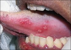 Herpetic Gingivostomatitis Activation of dormant Herpes Simplex Virus Type I (HSVII associated with genital lesions, although may be found in oral