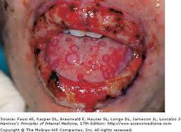 Stevens-Johnson Syndrome severe life-threatening form of Erythema Multiforme Spontaneously (50%) or hypersensitivity reaction (medication or infection SSx: widespread lesions