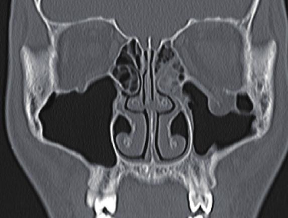 (C) Coronal computed tomography scans show nonsignificant findings. CT, computed tomography. A B C than 60 minutes showed an odds ratio of 1.42.