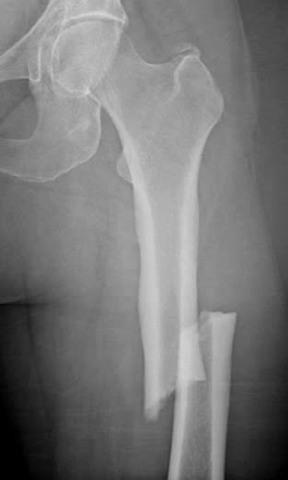 Atypical femoral fractures Associated with anti-resorptive therapy Estimated relative risk varies considerably Absolute risk is low